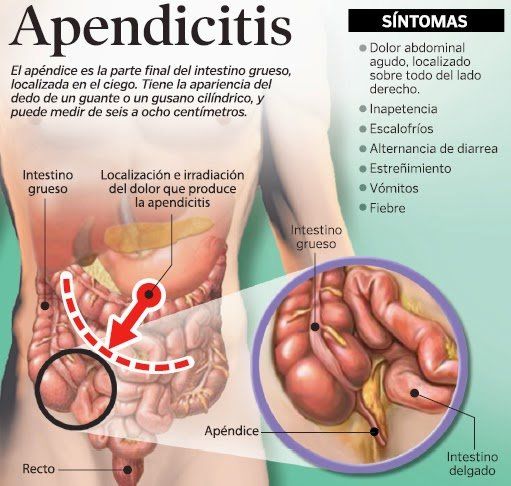 sintomas de un apendicitis aguda