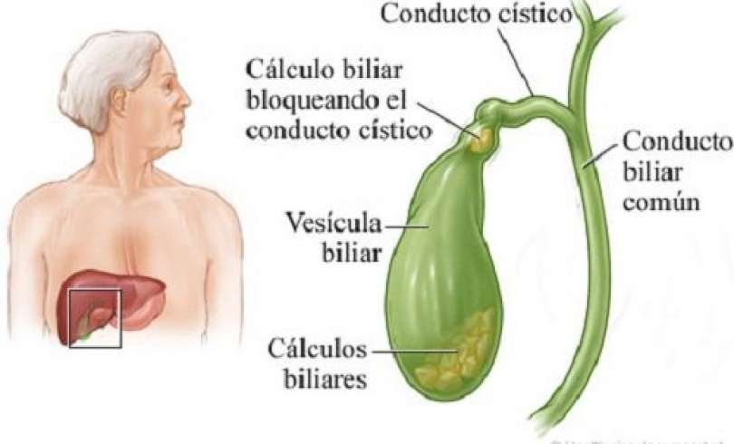 dieta para pacientes calculos biliares dieta para pacientes calculos biliares