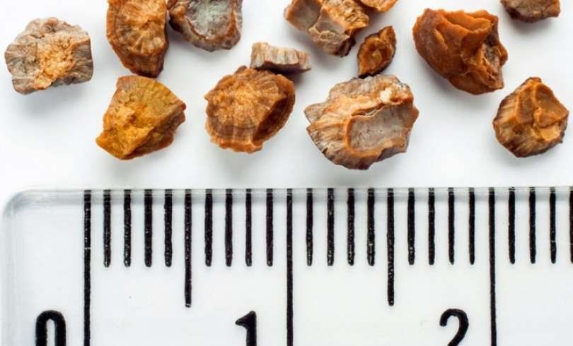 como eliminar calculos en los riñones de manera natural