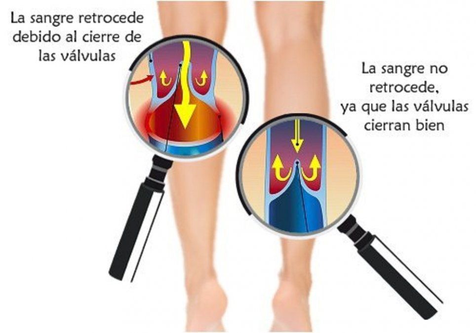 Cosquilleo en las piernas causas