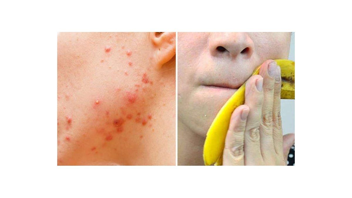 beneficios de <a href= beneficios de frotar cascara de platano en la cara