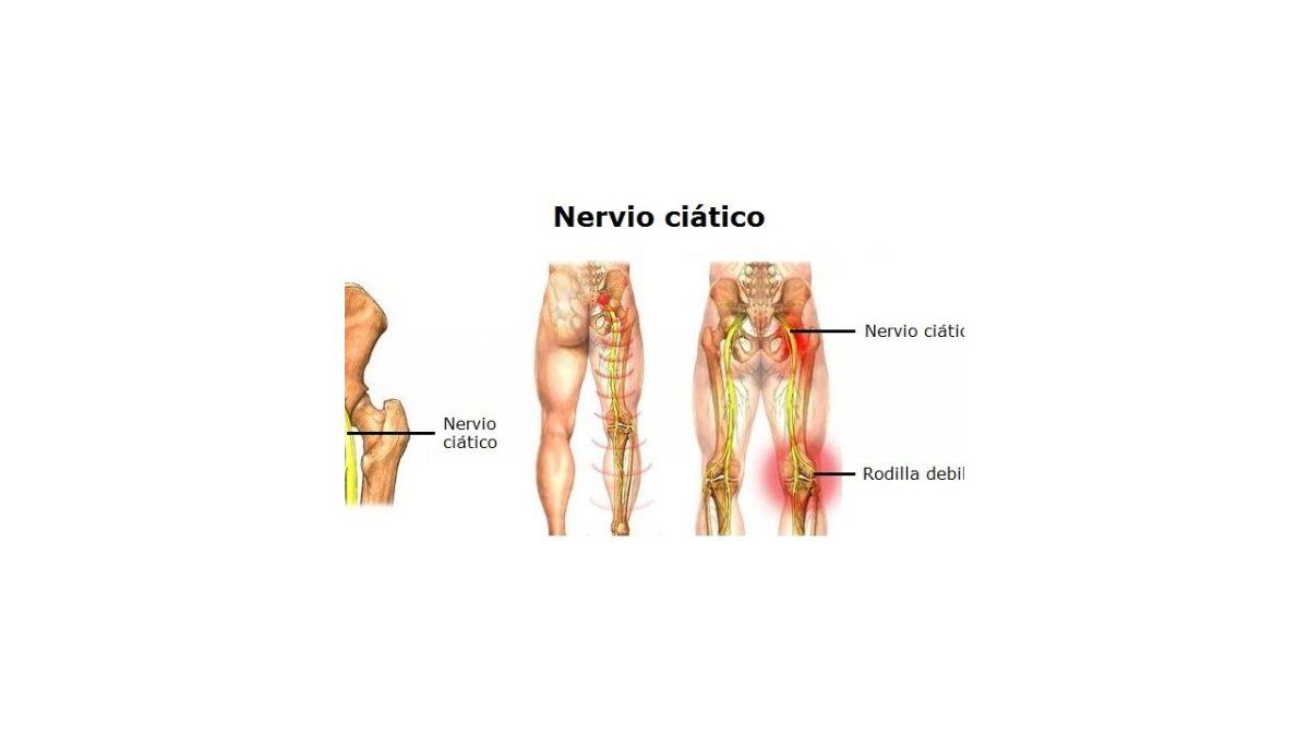 como liberar el nervio ciatico