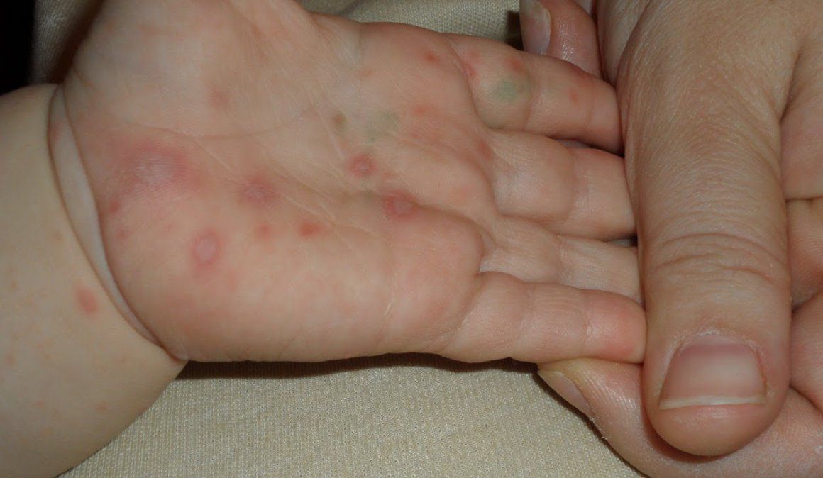 tratamiento para enfermedad de manos pies y boca tratamiento para enfermedad de manos pies y boca