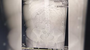 Salió de La Quiaca con 90 cápsulas de cocaína en su organismo y se descompensó