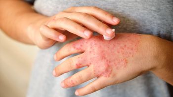Dermatitis Atópica: continúa la campaña de detección gratuita