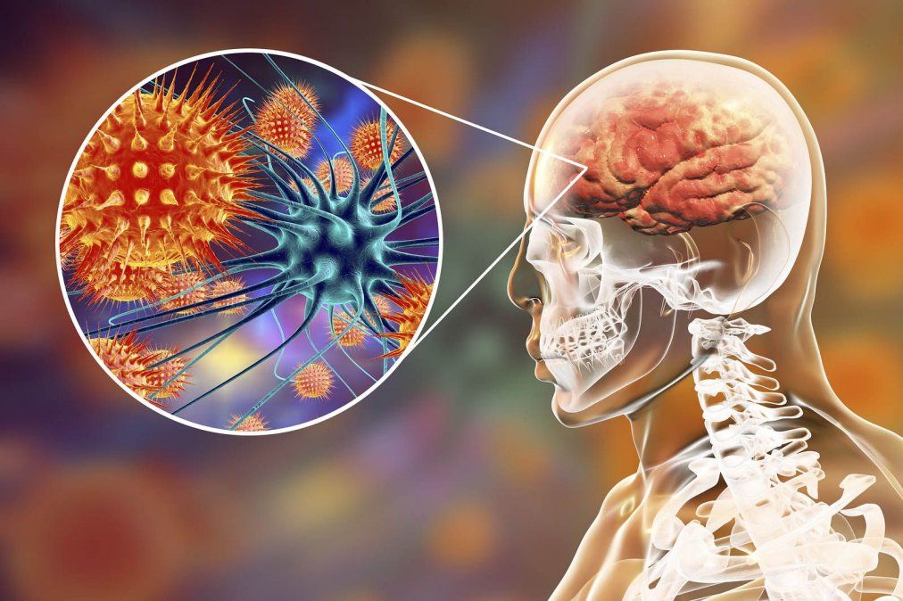 Meningitis: La OMS quiere erradicarla en 2030
