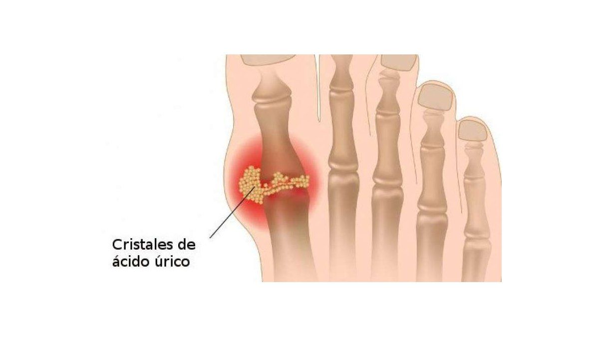 Descubre qué es el Ácido úrico y cómo controlarlo