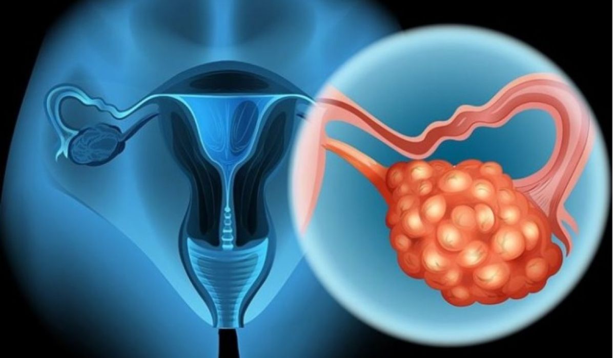 Nuevo medicamento oral para pacientes con cáncer de ovario