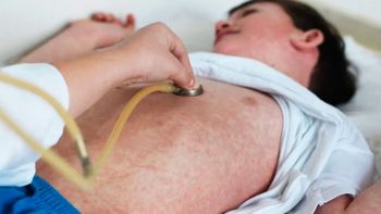 Reportan un caso de sarampión en Entre Ríos y se reactiva la alerta sanitaria nacional