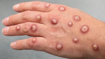 Viruela del mono: Argentina registra el primer caso de Clado Ib