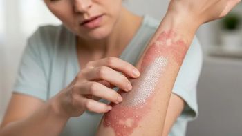 Continúa la campaña de detección gratuita de enfermedad Psoriásica