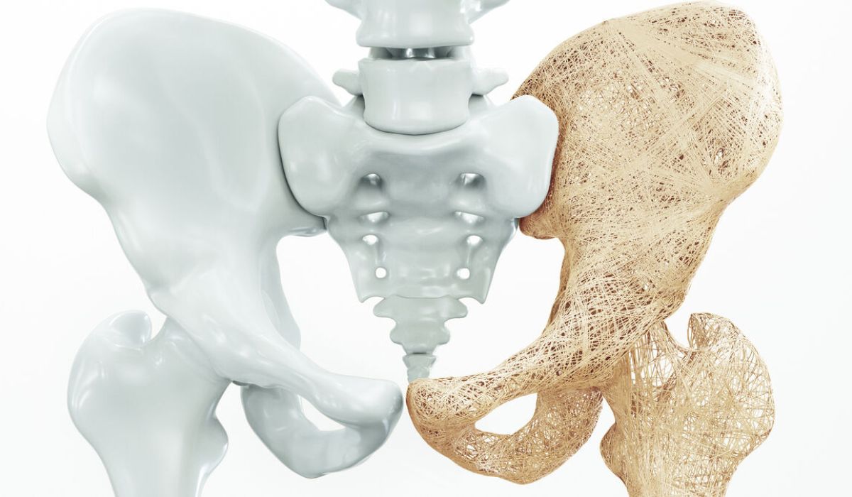 Toda fractura es osteoporosis hasta que se demuestre lo contrario